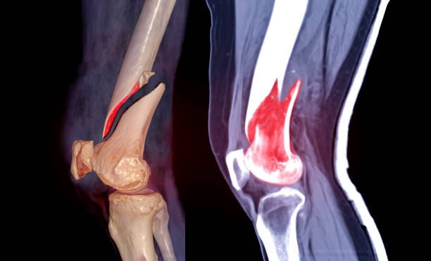 istock CT knee joint 3D rendering image lateral view and Sagittal view isolated on black background showing fracture Femur bone. 1321723701