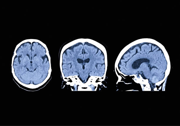 коллекция кт головного мозга axial , sagittal , корональная плоскость с направляющий линии позиционирования. компьютерная томография мозга. эффек - brain mri scanner mri scan medical scan стоковые фото и изображения