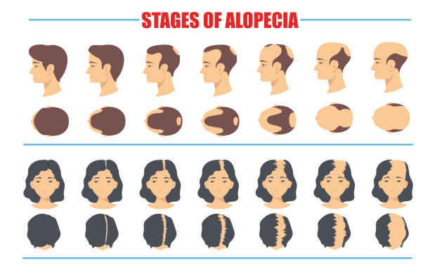 ilustrações, clipart, desenhos animados e ícones de estágios de ilustrações vetoriais de alopecia masculinas e femininas definidas - alopecia antes depois