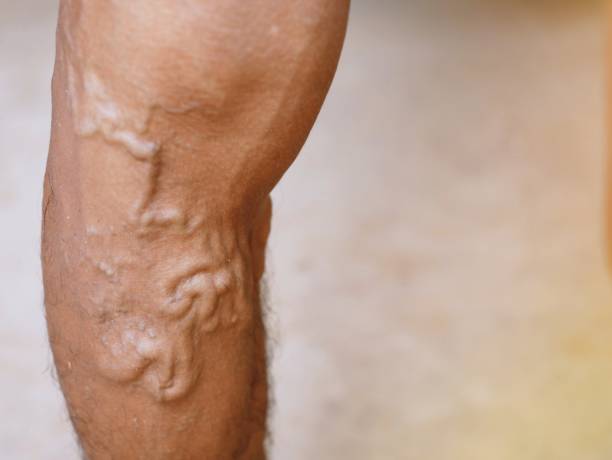 The severity of the varicose veins The severity of the varicose veins ranges from the tiny capillaries, pain in the legs, swollen feet and legs, and the crooked aneurysm resembles a worm. spider veins stock pictures, royalty-free photos & images