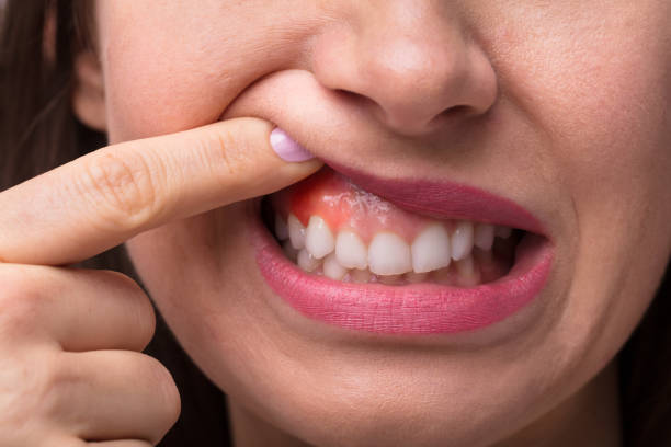 Woman Showing Swelling Of Her Gum Close-up Of A Woman's Finger Showing Swelling Of Her Gum bubble gum photos stock pictures, royalty-free photos & images