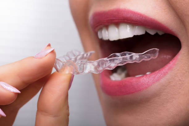 istock Woman Putting Transparent Aligner In Teeth 1322055056
