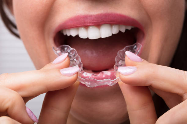 istock Woman Putting Transparent Aligner In Teeth 1322055058