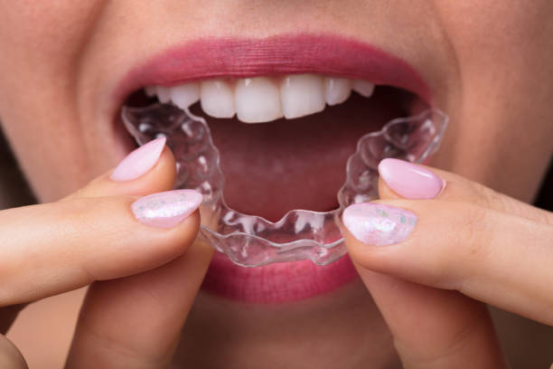 istock Woman Putting Transparent Aligner In Teeth 1322055061