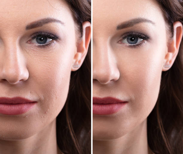 istock Woman's Face Before And After Cosmetic Procedure 1322055855