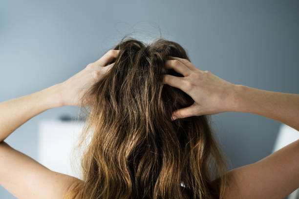 Itching Dry Head Scalp Itching Dry Head Scalp And Long Hair With Dandruff scratching stock pictures, royalty-free photos & images