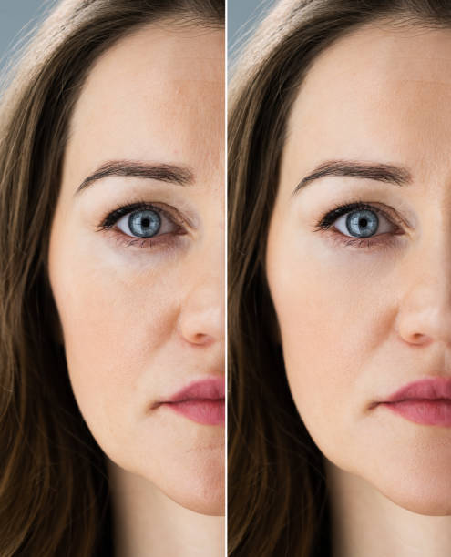 istock Anti Age Rejuvenation Lift Before 1322057130