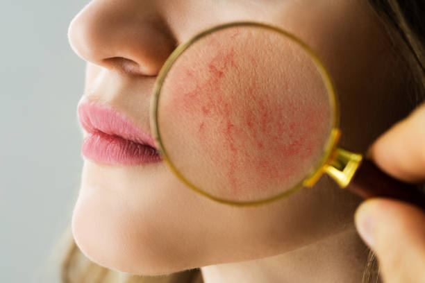 examen de la peau du visage avec des problèmes de rosacée - cheek color photos et images de collection