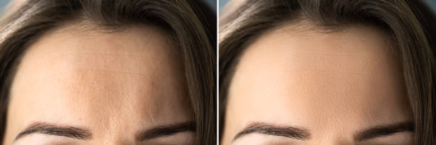 Anti Age Rejuvenation Forehead Lift Before Anti Age Rejuvenation Forehead Lift Before And After wrinkled forehead stock pictures, royalty-free photos & images