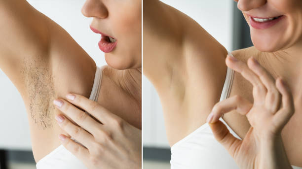 istock Laser Electrolysis IPL Hair Removal Before 1322057154