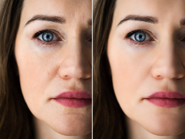 istock Anti Age Rejuvenation Lift Before 1322057156
