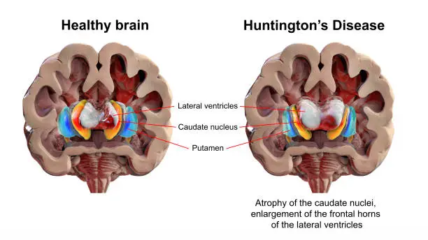 Dorsal striatum and lateral ventricles in healthy brain and in Huntington's disease, 3D illustration showing enlargement of anterior horns of lateral ventricles and atrophy of the caudate nuclei in HD