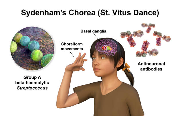 sydenham's chorea, an autoimmune disease that results from streptococcus infection - corpus striatum imagens e fotografias de stock