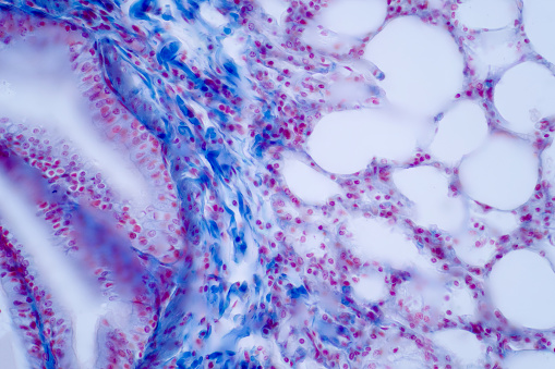 Human lung pathology under light microscope, The lungs is organs of the respiratory system in human. Human pathology education. Haematoxylin and eosin staining technique slide.