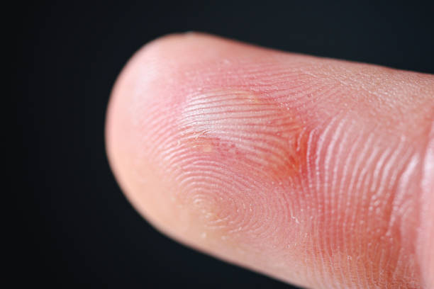 istock Callus on the middle finger of man's hand 1322249020