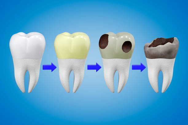 istock Scheme of sequential tooth deterioration from a healthy tooth to a lost tooth. 3d rendering. 1322279441