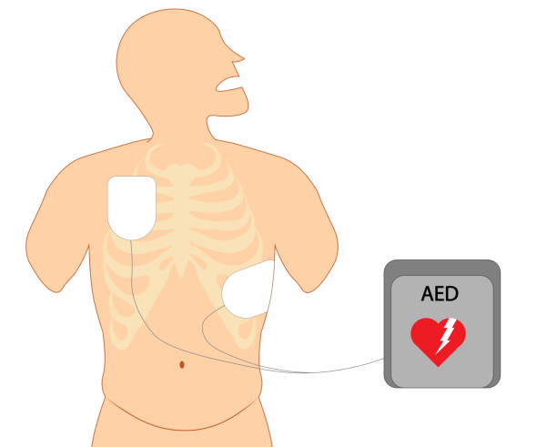 defibrillator-elektrodenposition. elektrode brustposition zu schwächen schock. - electrode stock-grafiken, -clipart, -cartoons und -symbole