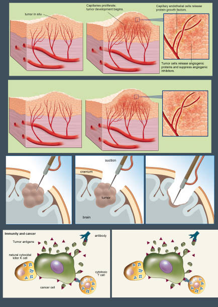 Cancer Extraction 20+ Gty Illustrations, Royalty-Free Vector Graphics & Clip Art - iStock