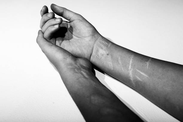 The scarred arms of a young woman A black and white photo of the arms of a girl who practiced self-harm. Several scars are visible. self harm photos stock pictures, royalty-free photos & images