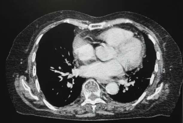 Photo of CT scan (computed tomography) of chest organs.