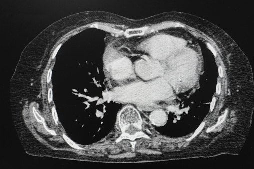 CT Abdomen Cross section View. CT scan (computed tomography) of chest organs.