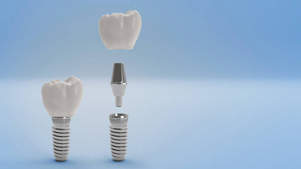 implant dentaire - artificial metal healthcare and medicine technology photos et images de collection