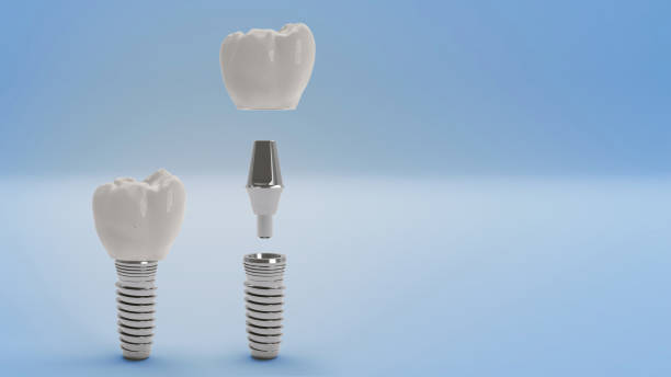 имплантат зубов - teeth implant стоковые фото и изображения