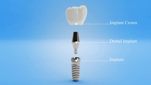 3D Teeth Implant - 4K Resolution