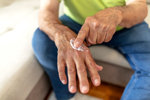 Un hombre mayor que usa crema de manos contra las venas varicosas. photo