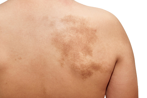 Close-up of birthmark on man's back, studio shot。