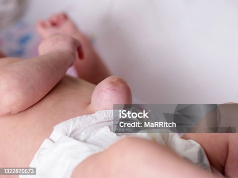 300+ Umbilical Hernia Stock Photos, Pictures & Royalty-Free Images