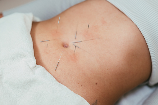 Woman lying down and having an acupuncture treatment on her stomach in an alternative medical clinic