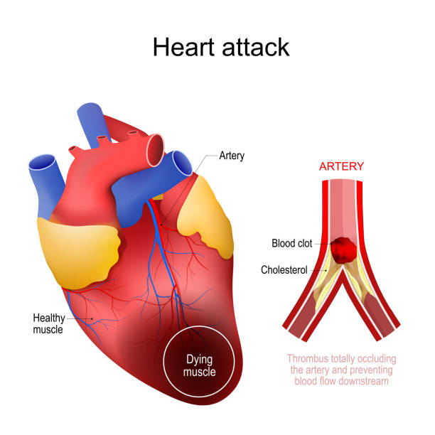 zawał serca. zawał - human artery cholesterol atherosclerosis human heart stock illustrations