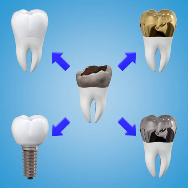 istock Scheme of different options for prosthetics of a damaged tooth. 3d rendering. 1323029289