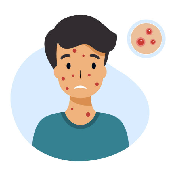 Boy With Chickenpox Symptoms Skin Rashes And Pimples Vector Character In  Flat Style Stock Illustration - Download Image Now - iStock