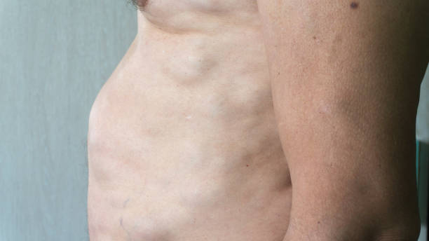 istock A man with lipomas - benign tumors on the body. multiple lipomas 1323172647