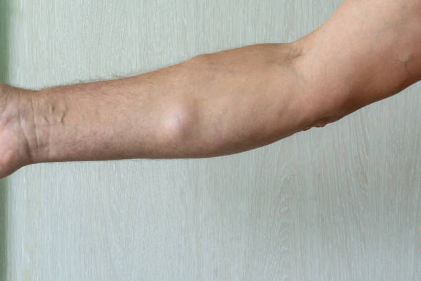 istock A man with lipomas - benign tumors on the body. multiple lipomas 1323172866