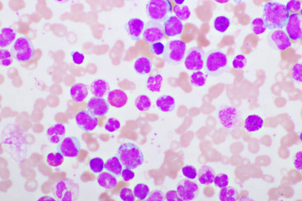 istock Chronic myeloid leukemia cells or CML 1323361552