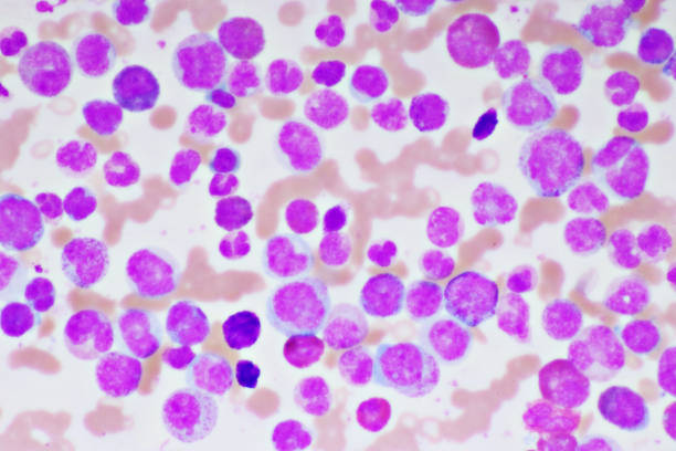 istock Chronic myeloid leukemia cells or CML 1323361554