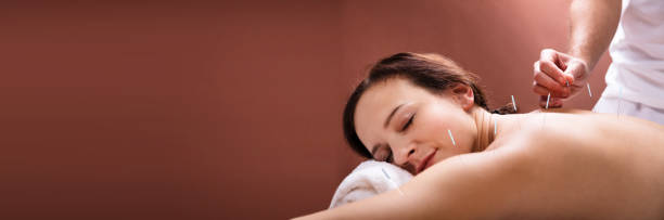 woman going through acupuncture treatment - acupuncturist imagens e fotografias de stock