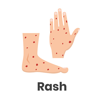 Hemorrhagic rash icon on feet and hands conceptual vector illustration