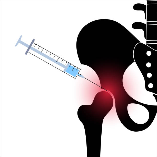 Bursofural Injeksi Bursitis Ilustrasi Foto Stok, Potret & Gambar Bebas Royalti - iStock
