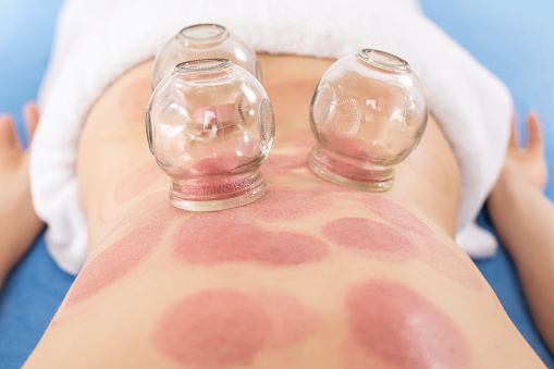 Vacuum Cupping Therapy background. Treatment used in Traditional Chinese Medicine for pain relief and other health benefits.