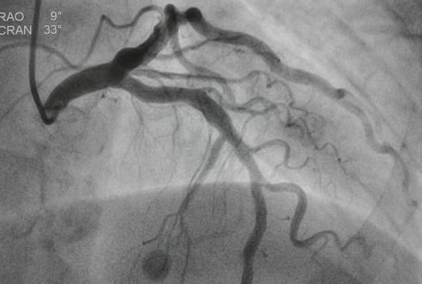 koronares angiogramm - human heart heart attack x ray image chest stock-fotos und bilder