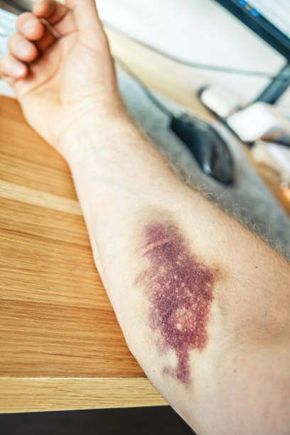 istock Man shows bruise from vein injection on forearm at table 1323521768
