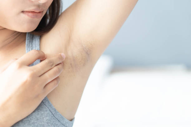 istock Women problem black armpit lying on white bed background for skin care and beauty concept, selective focus 1323607217