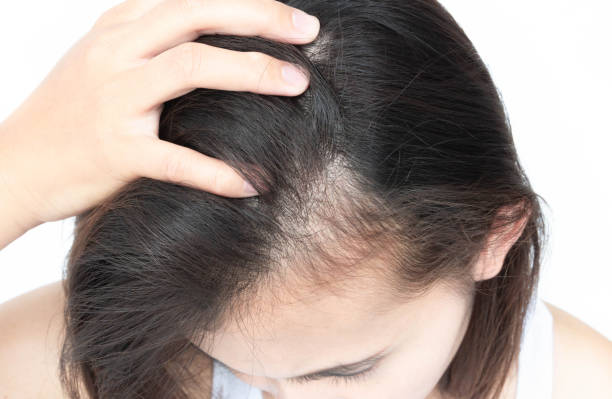 Hair Loss: Medications & Treatment Options 