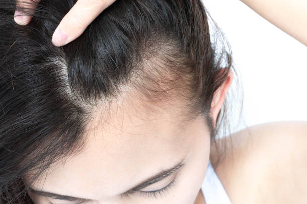 problème de perte de cheveux grave femme pour le shampooing de soins de santé et le concept de produit de beauté - human scalp photos et images de collection