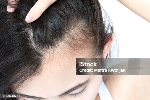 33,082 Female Hair Loss Stock Photos, Pictures & Royalty-Free Images -  iStock | Hair loss woman, Alopecia, Thinning hair