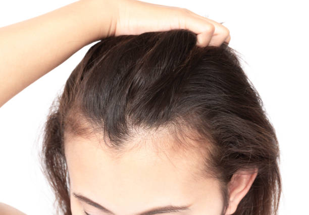 Woman serious hair loss problem for health care shampoo and beauty product concept Woman serious hair loss problem for health care shampoo and beauty product concept woman hairline stock pictures, royalty-free photos & images